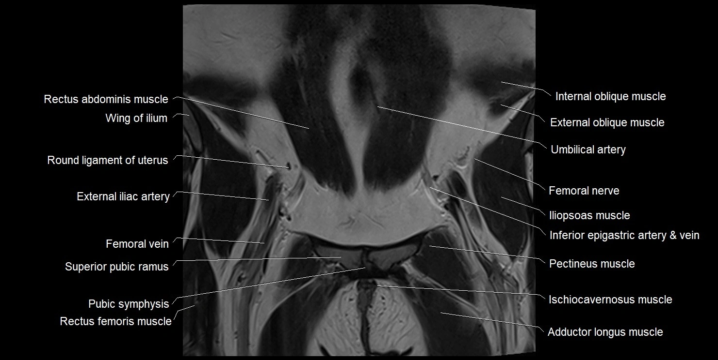 female pelvis coronal cross sectional anatomy image 7.webp